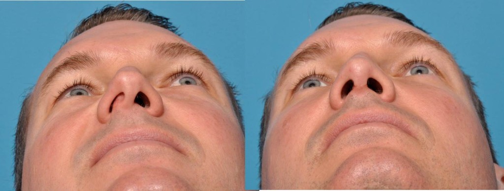 Sinus surgical procedure Septoplasty