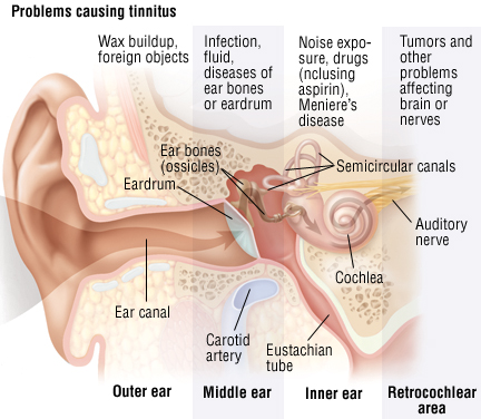 Causes-Tinnitus-Hearing