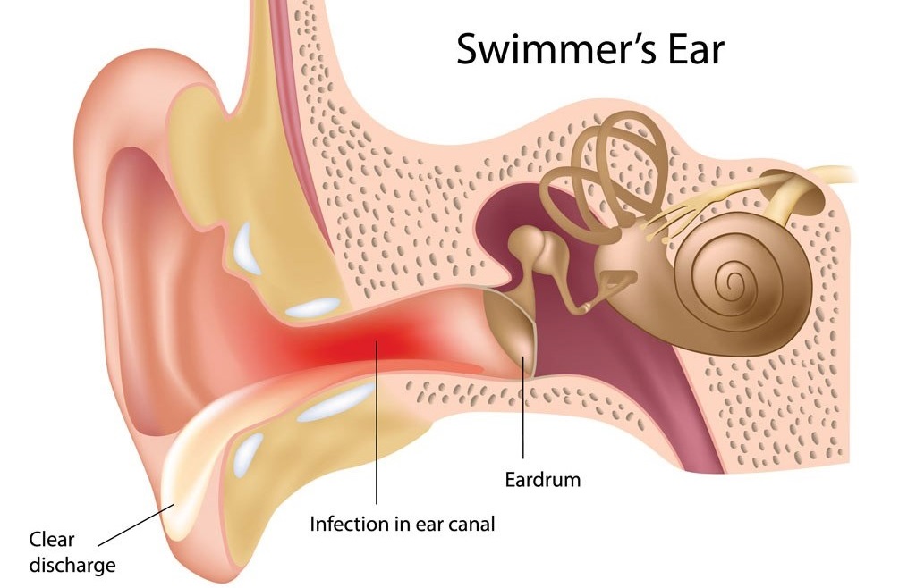 swimmers-ear-treatment