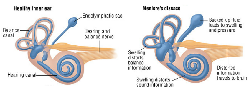 menieres disease