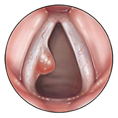 vocal-cord-lesion