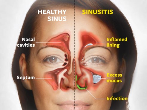nasal sinus infection